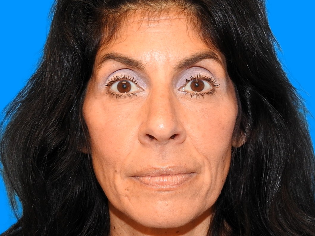 After Image: Patient Case #0114 - front