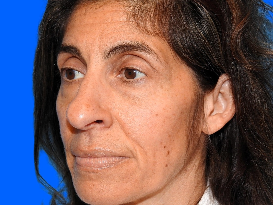 Before Image: Patient Case #0114 - left-front-oblique