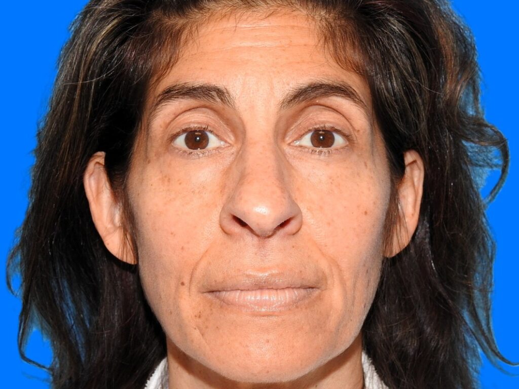 Before Image: Patient Case #0114 - front