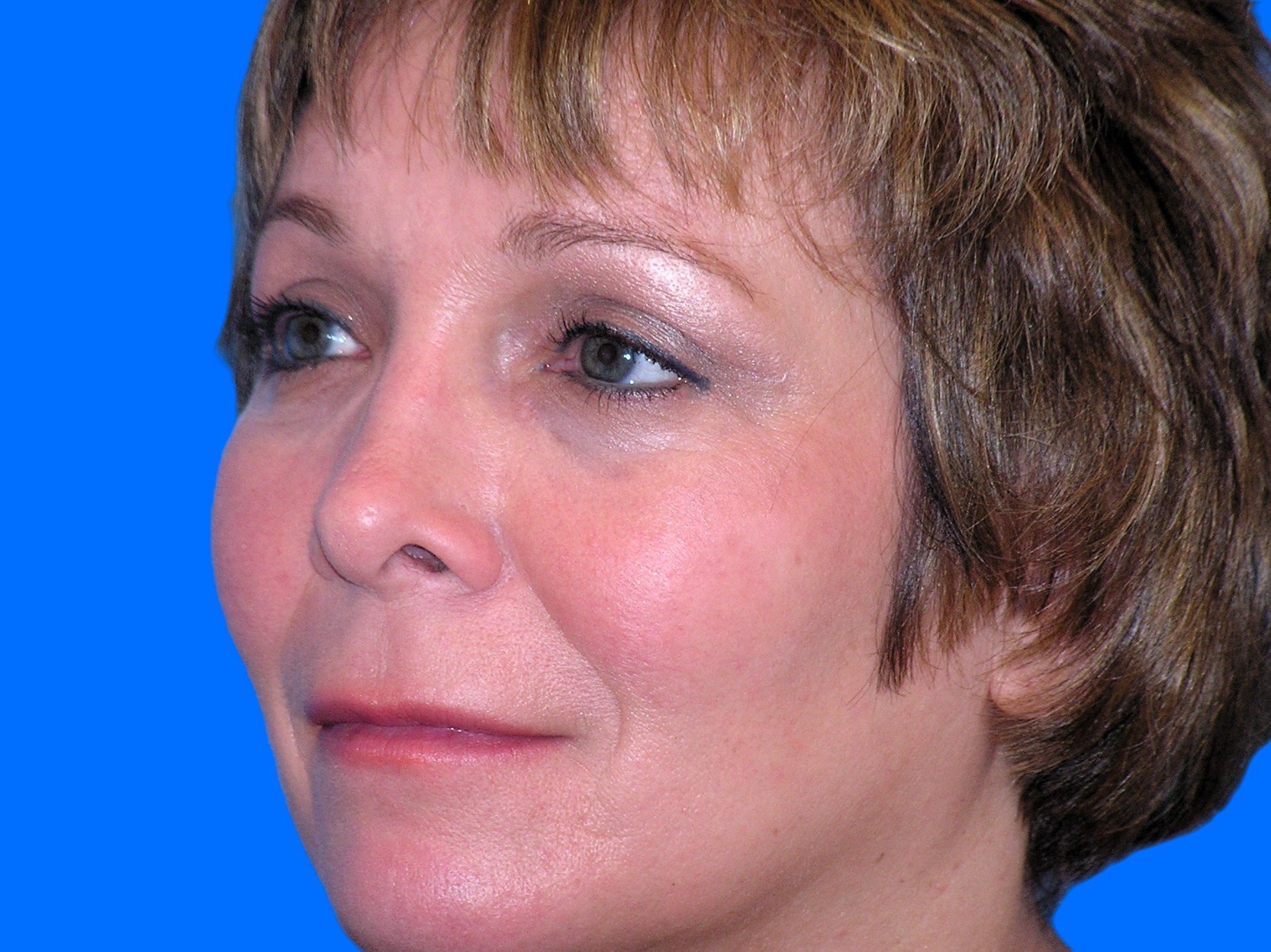 After Image: Patient Case #0115 - left-front-oblique