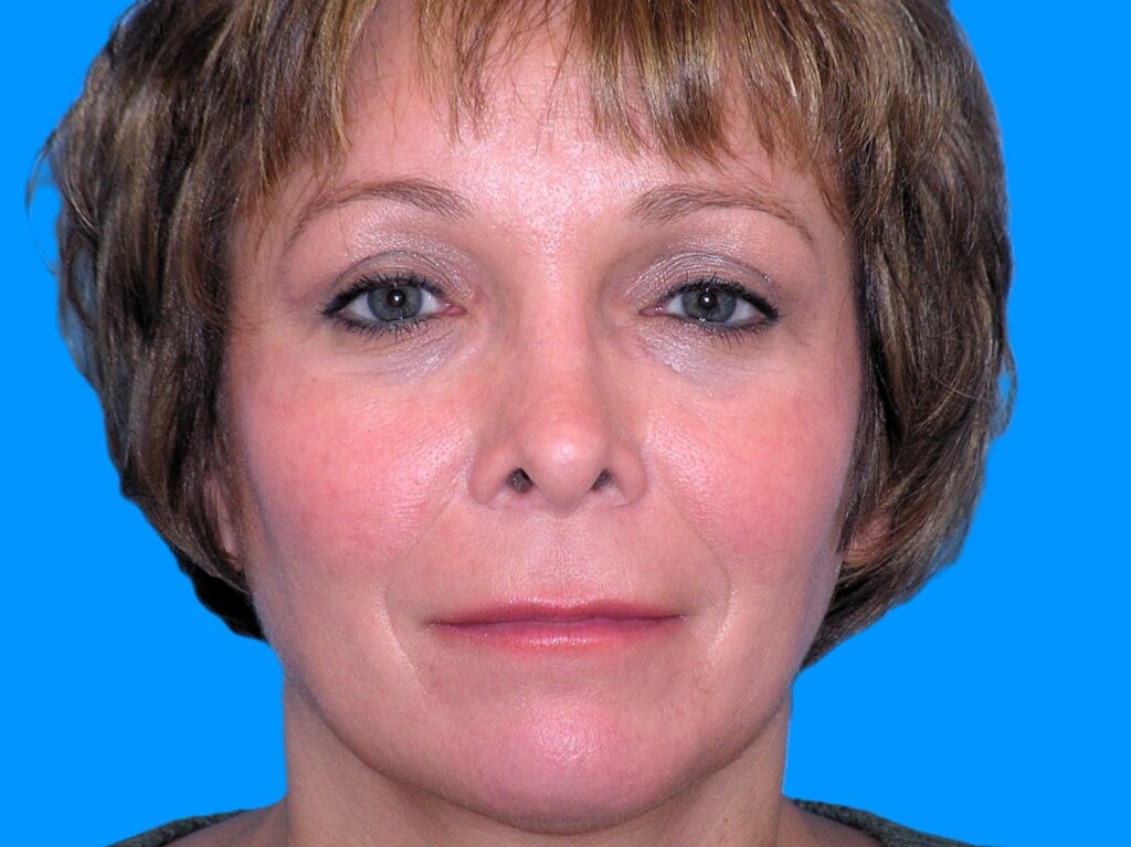 After Image: Patient Case #0115 - front