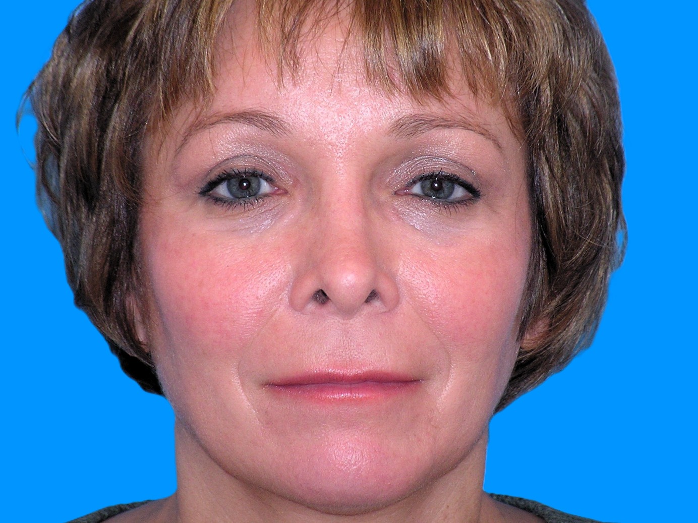 After Image: Patient Case #0115 - front