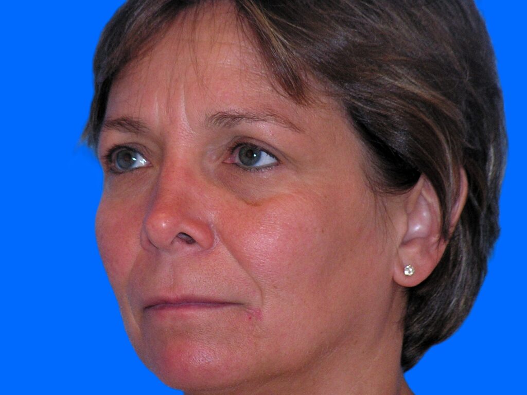 Before Image: Patient Case #0115 - left-front-oblique