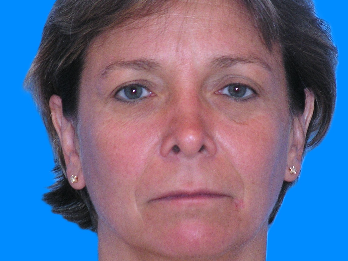 Before Image: Patient Case #0115 - front