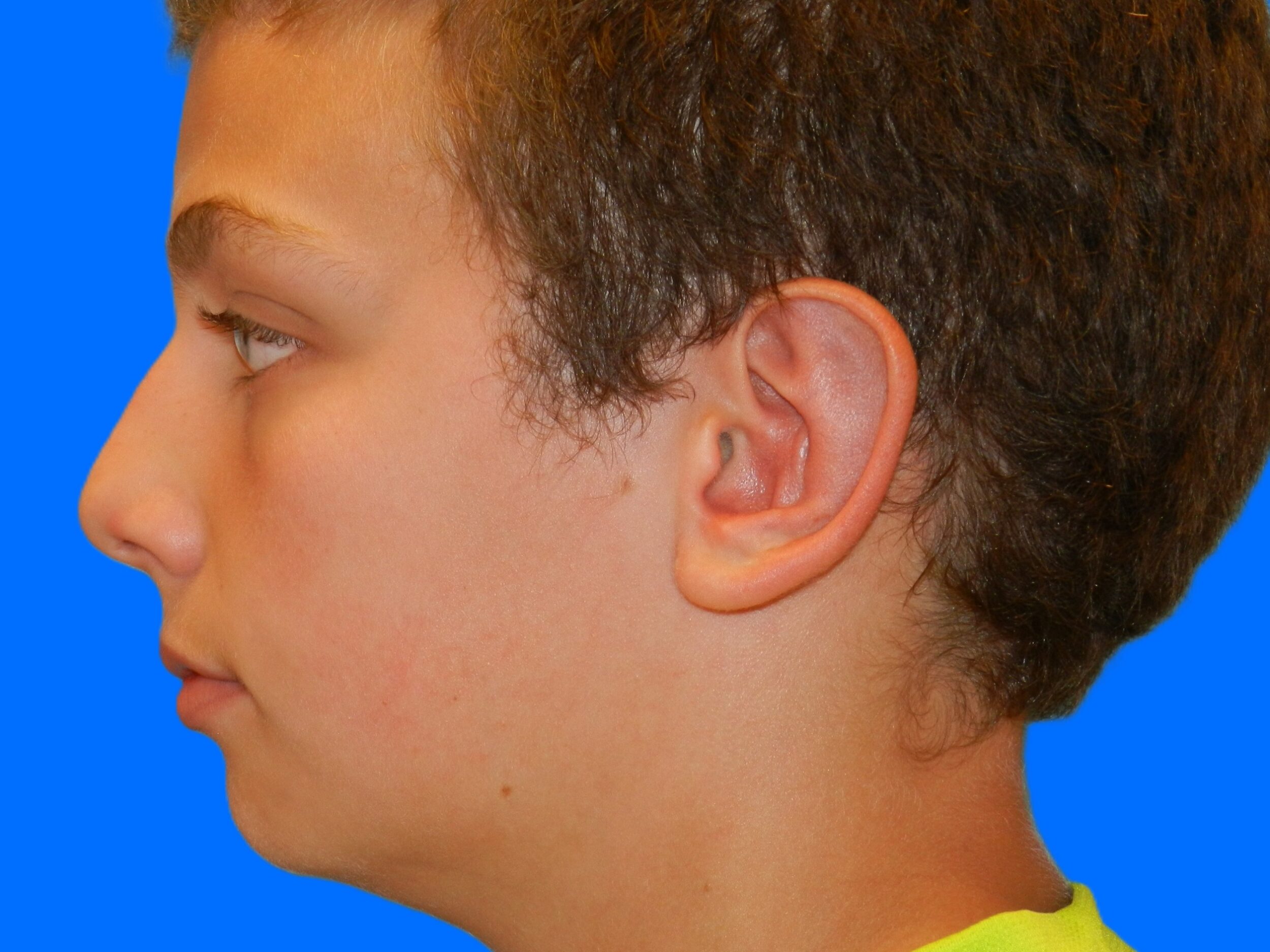 After Image: Patient Case #0116 - left-side