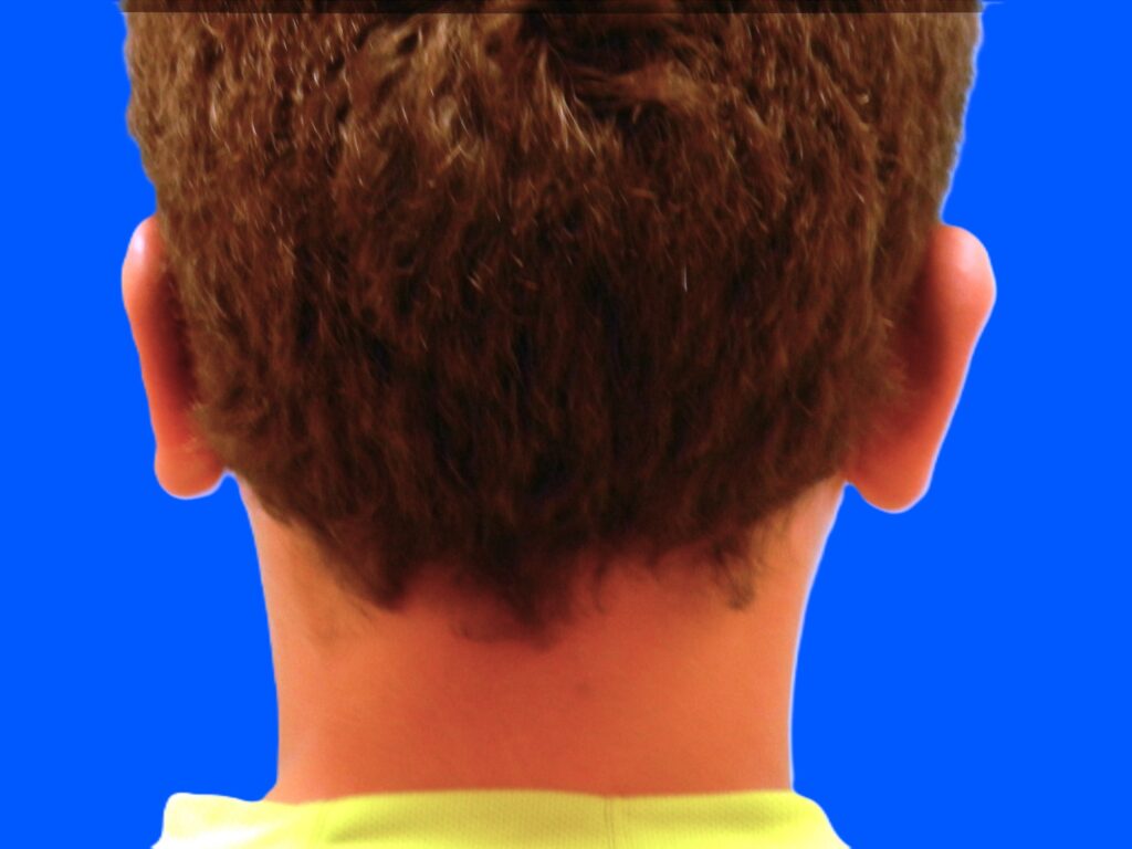 After Image: Patient Case #0116 - back