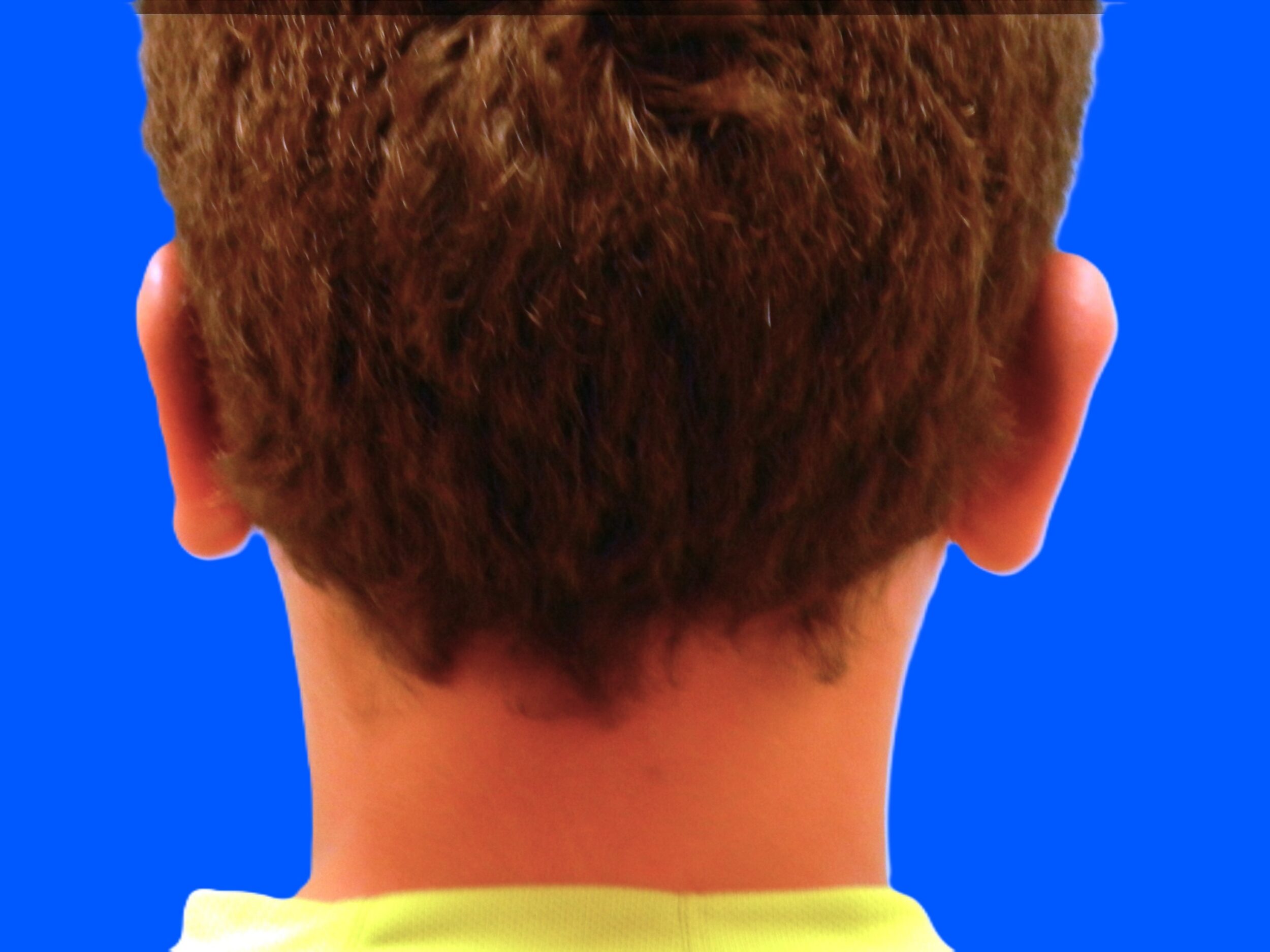 After Image: Patient Case #0116 - back