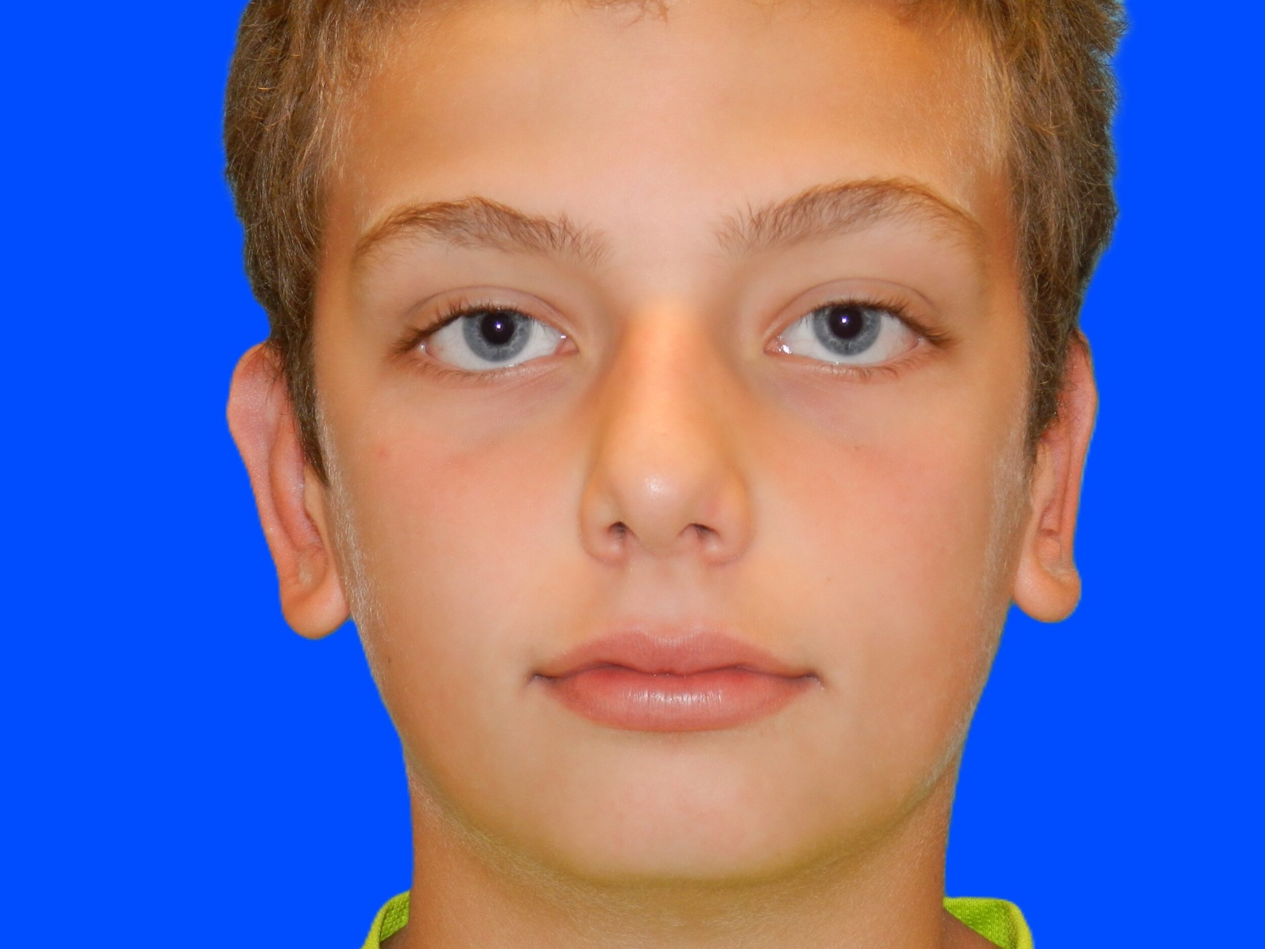 After Image: Patient Case #0116 - front