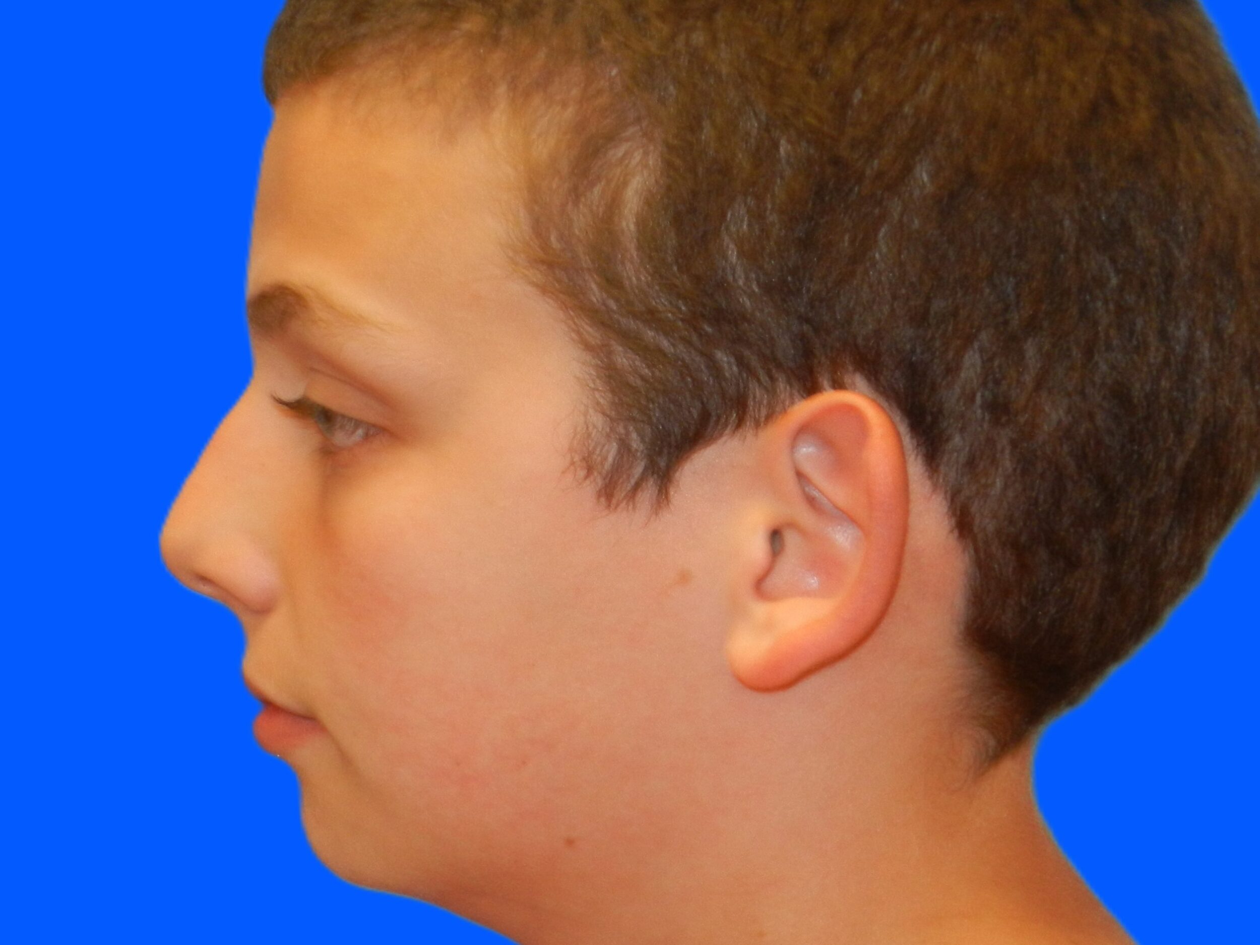 Before Image: Patient Case #0116 - left-side