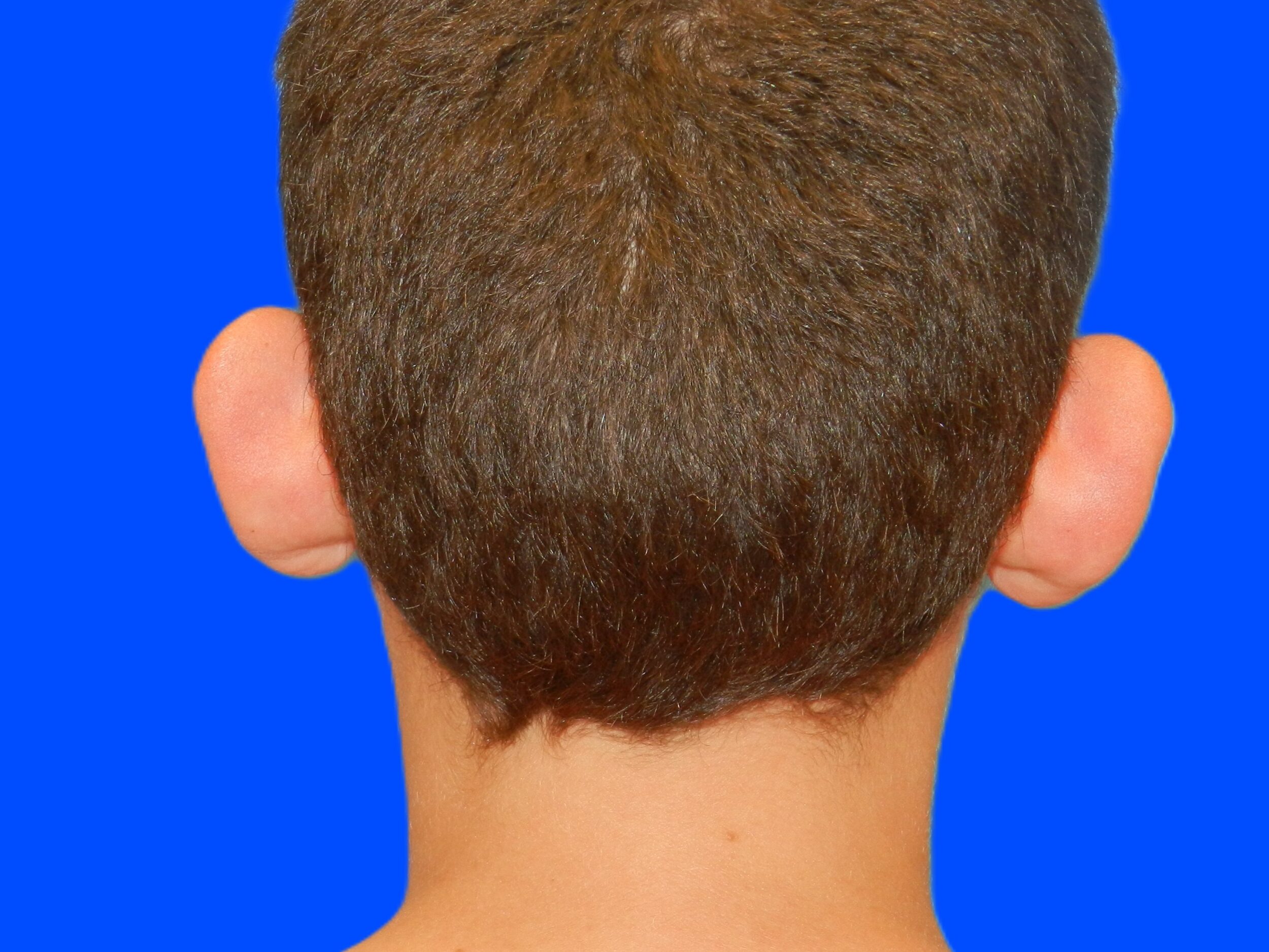 Before Image: Patient Case #0116 - back