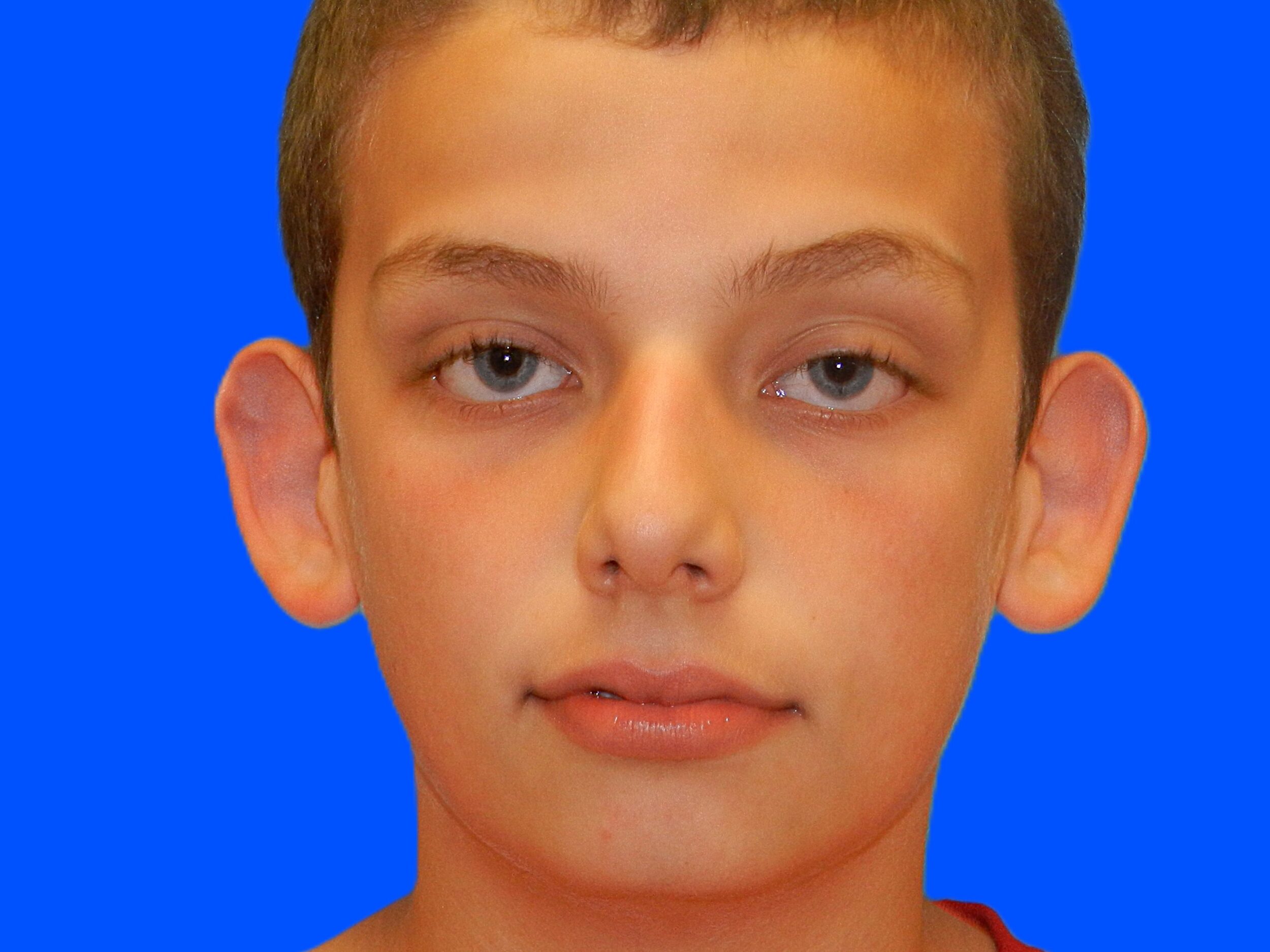 Before Image: Patient Case #0116 - front