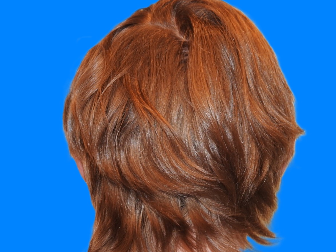 After Image: Patient Case #0117 - back