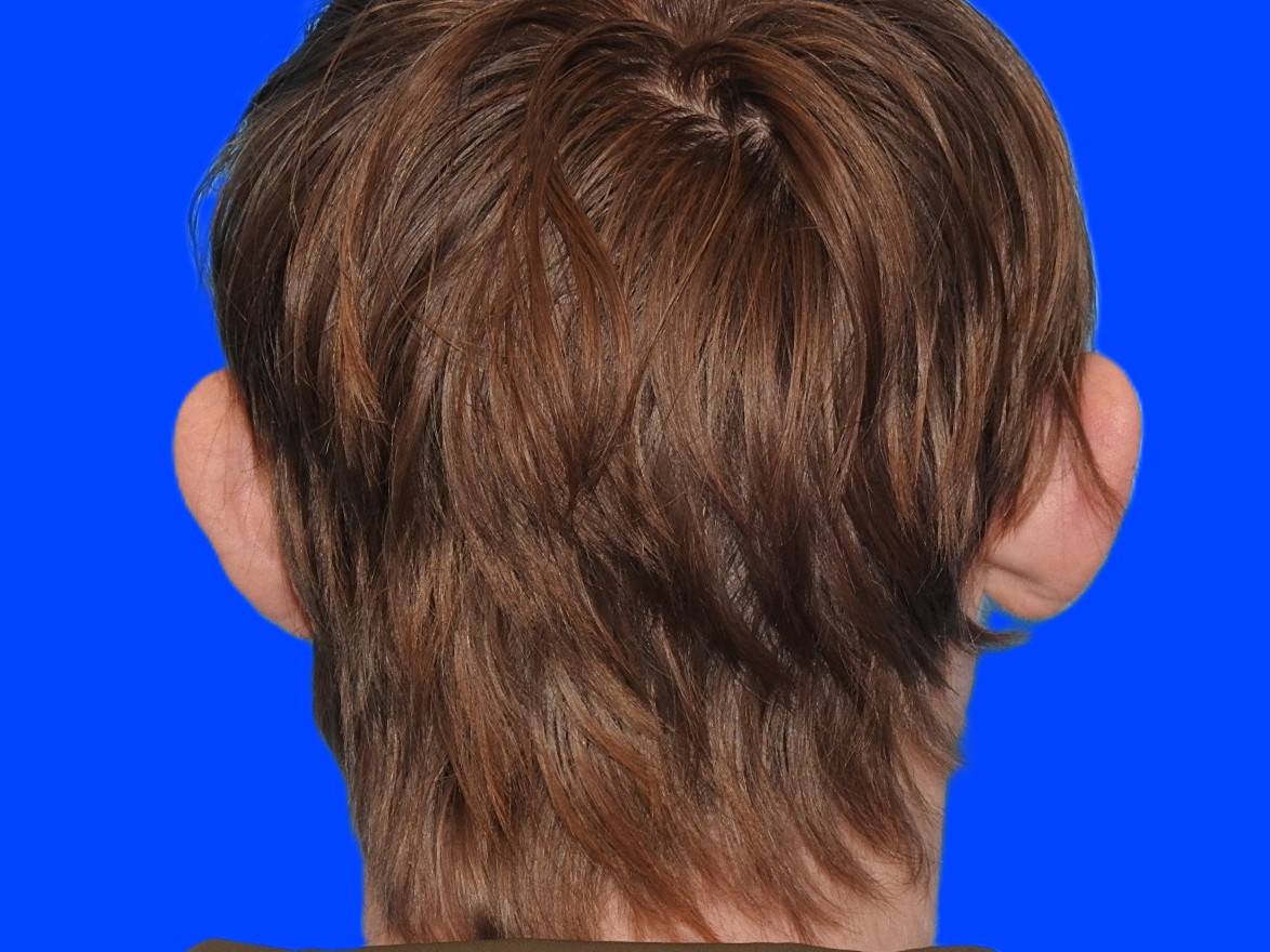 Before Image: Patient Case #0117 - back