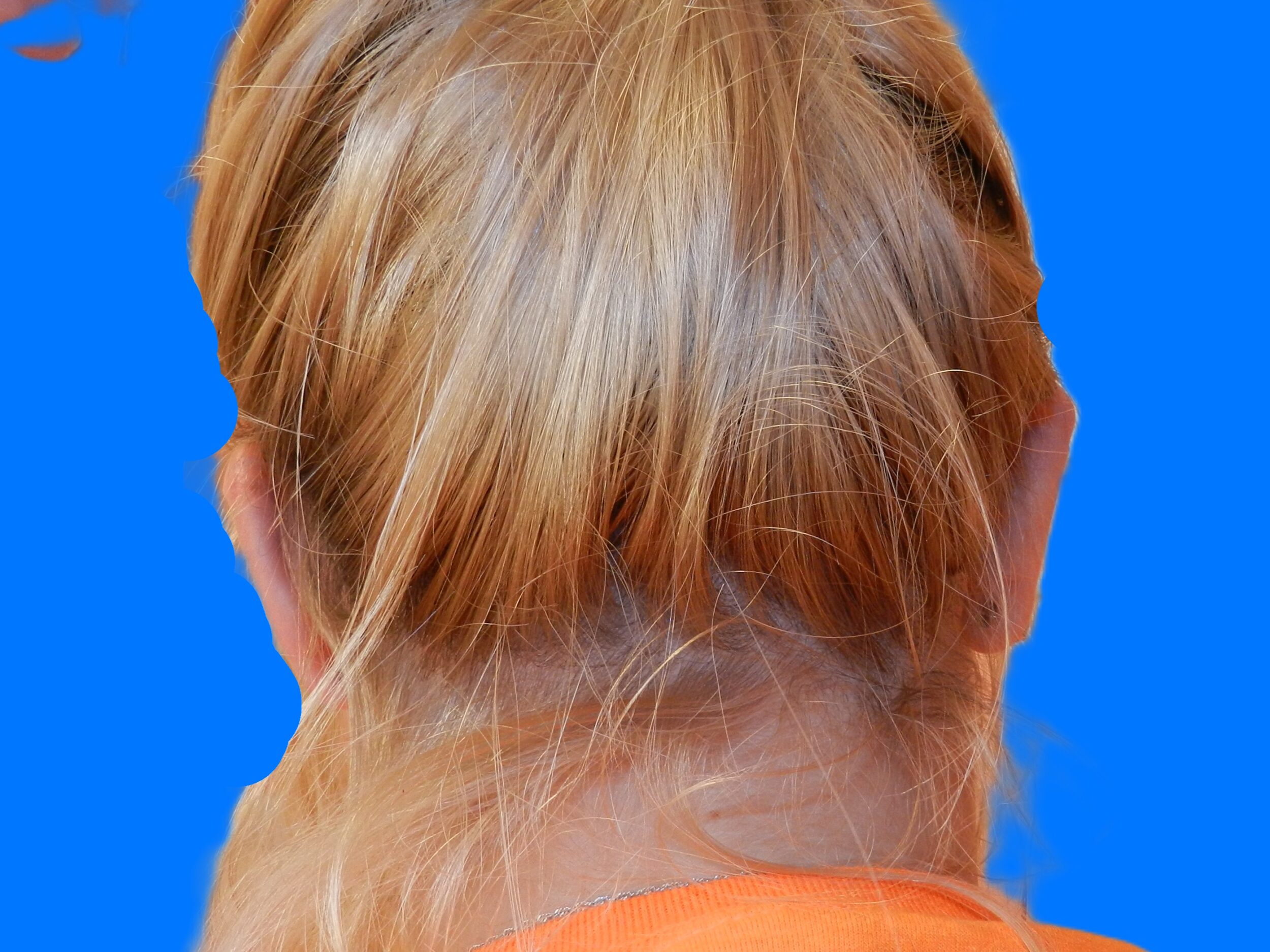 After Image: Patient Case #0118 - back