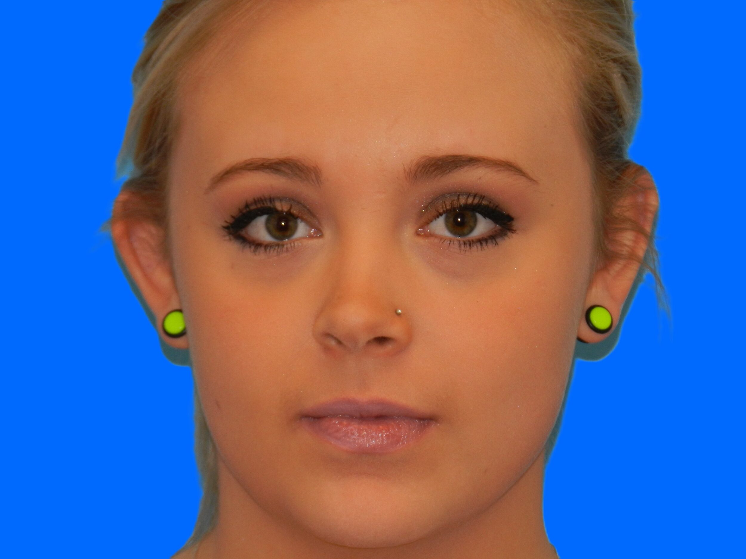 Before Image: Patient Case #0118 - front