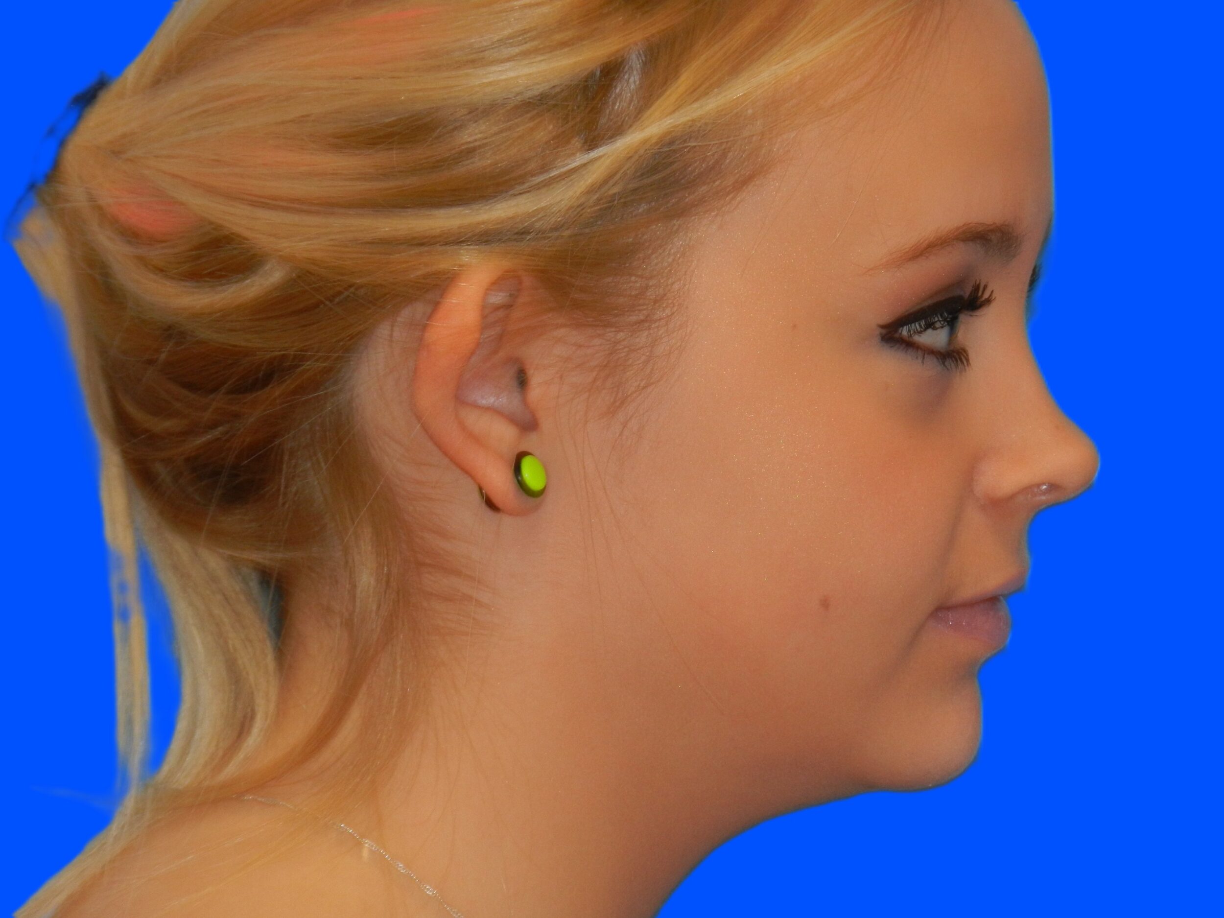 Before Image: Patient Case #0118 - right-side