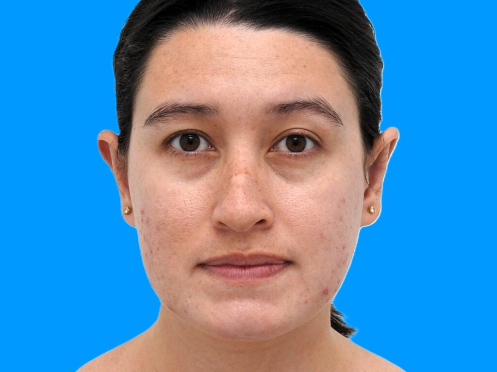 After Image: Patient Case #0119 - front