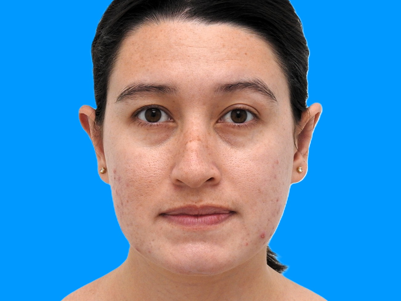 After Image: Patient Case #0119 - front