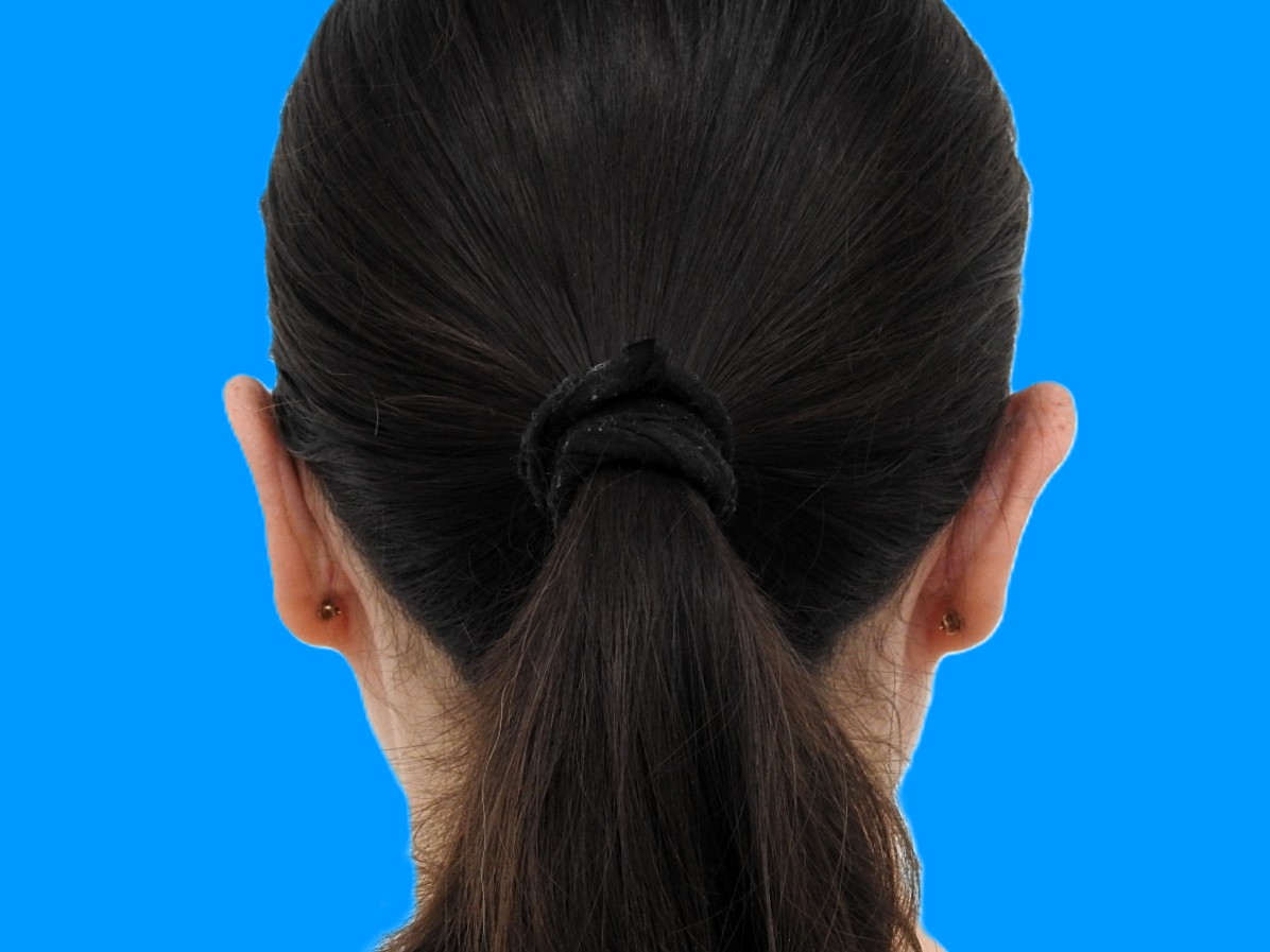 After Image: Patient Case #0119 - back