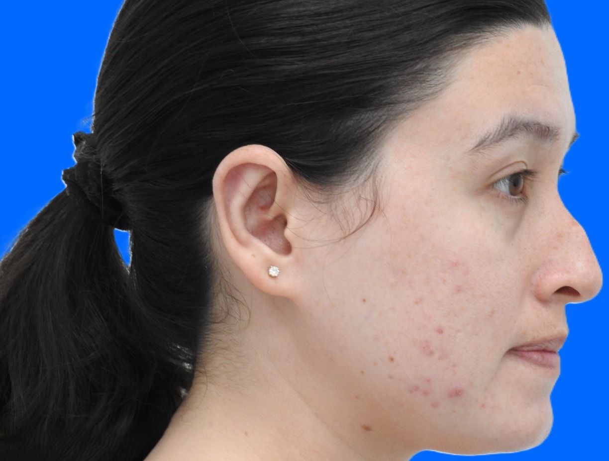 After Image: Patient Case #0119 - right-side