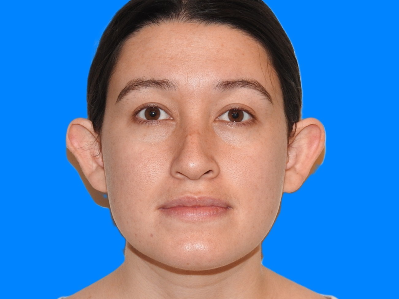 Before Image: Patient Case #0119 - front