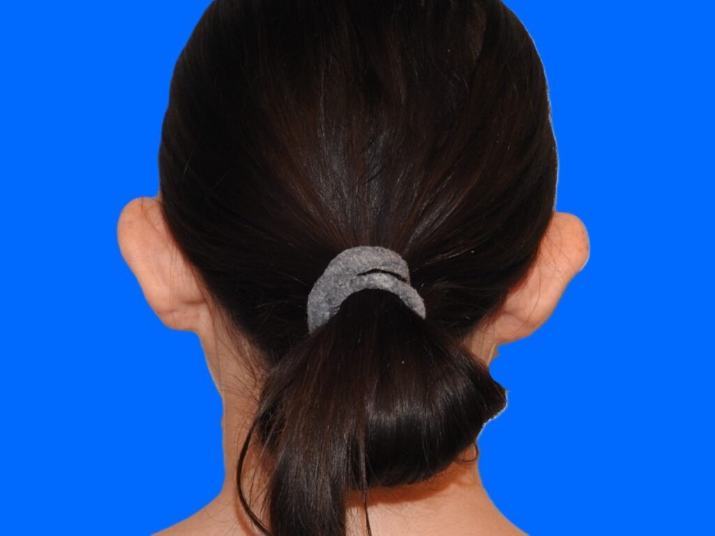 Before Image: Patient Case #0119 - back