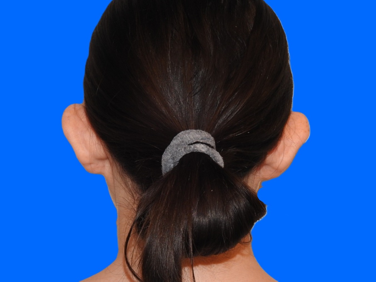 Before Image: Patient Case #0119 - back