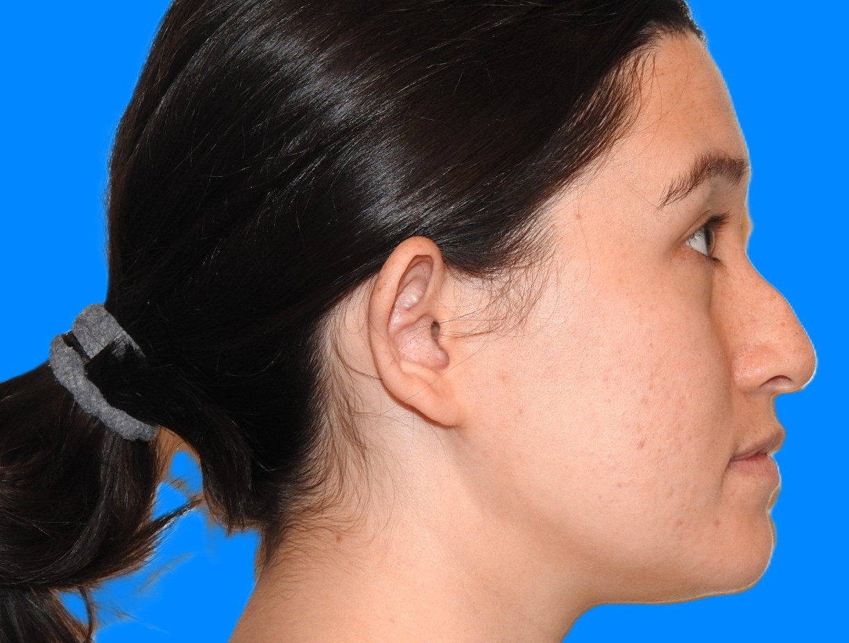 Before Image: Patient Case #0119 - right-side