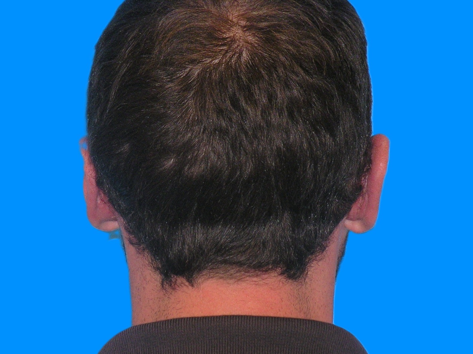 After Image: Patient Case #0120 - back