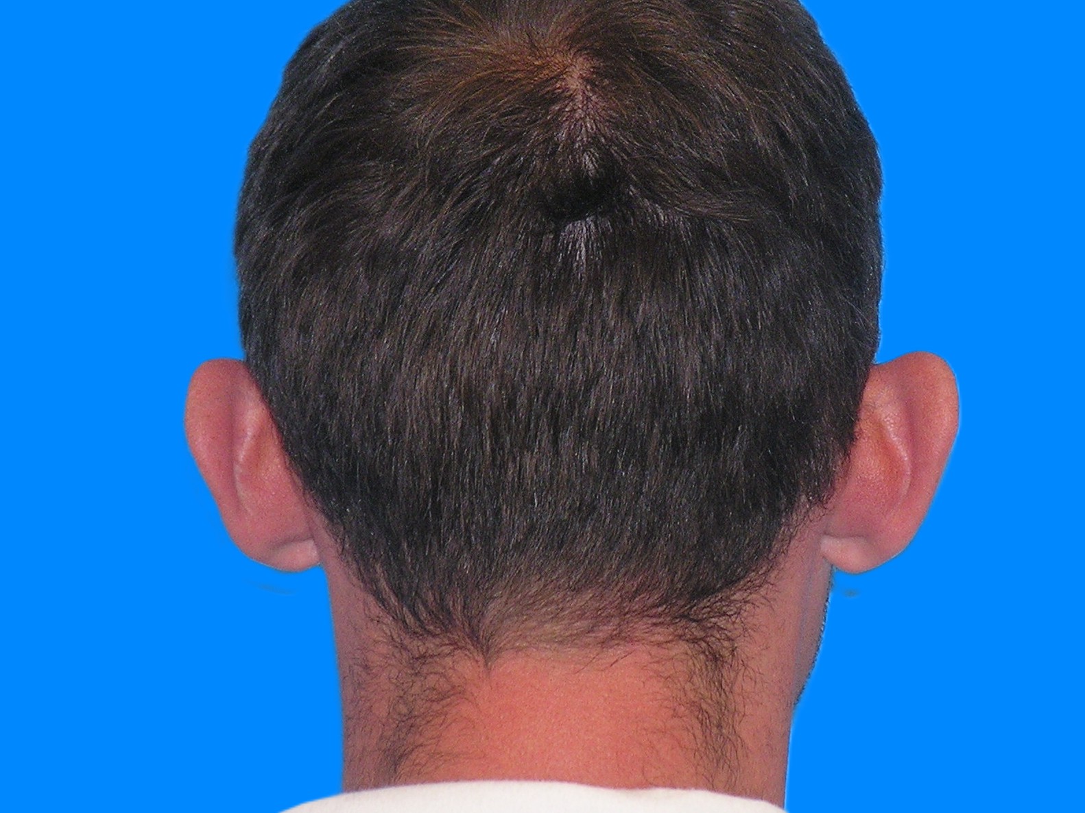 Before Image: Patient Case #0120 - back