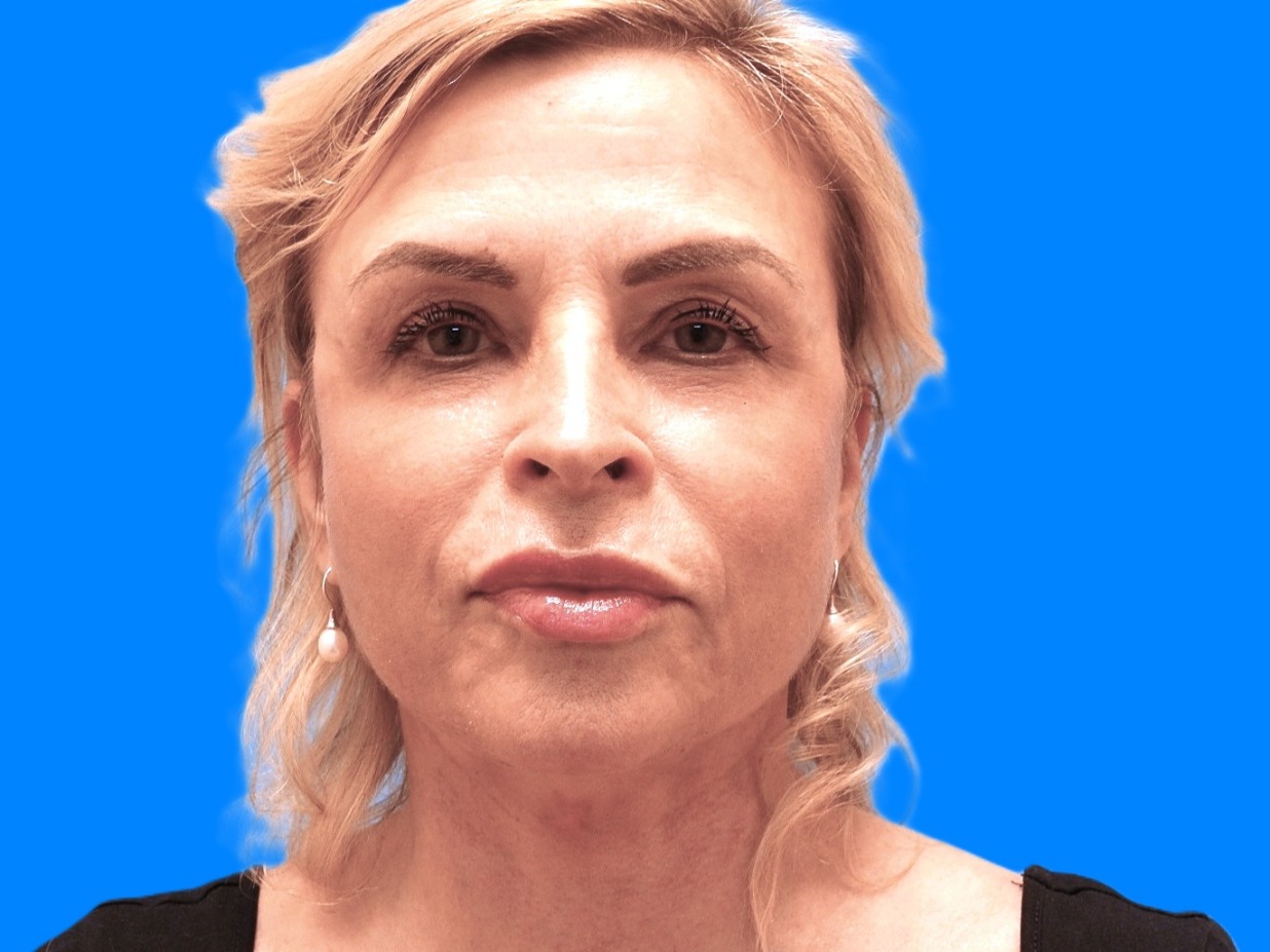 After Image: Patient Case #0121 - front