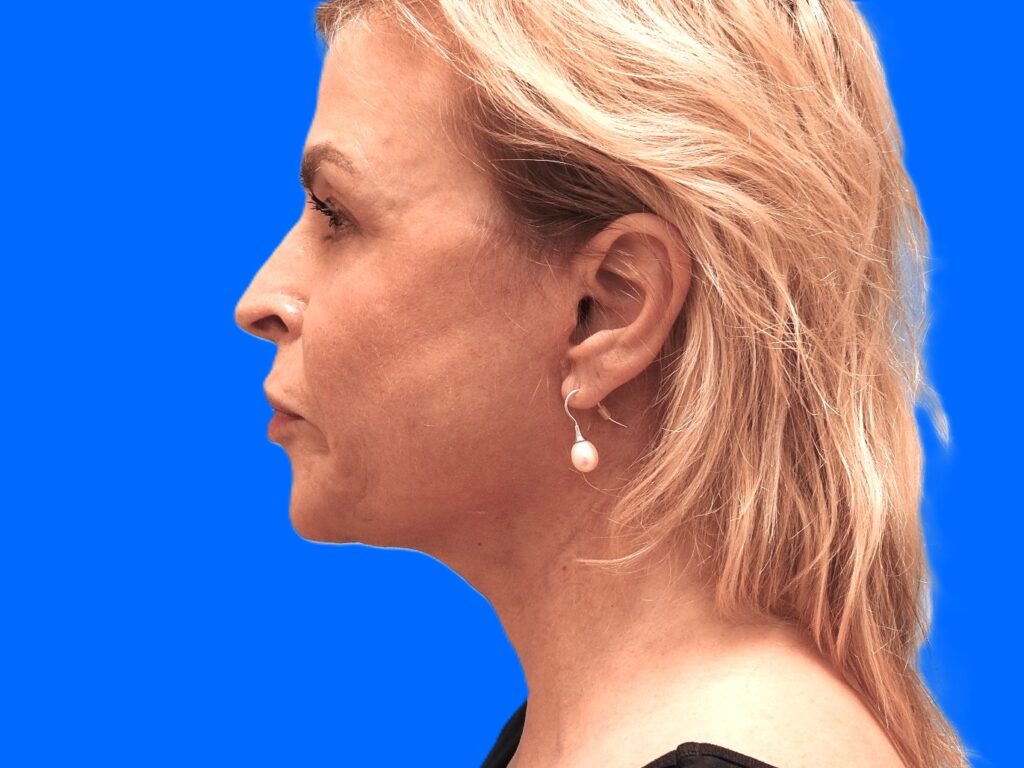 After Image: Patient Case #0121 - left-side