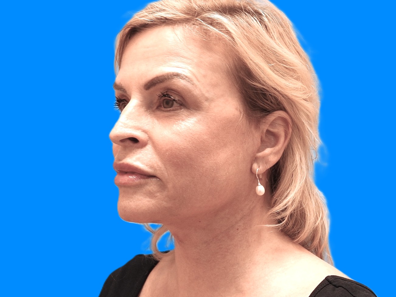 After Image: Patient Case #0121 - left-front-oblique