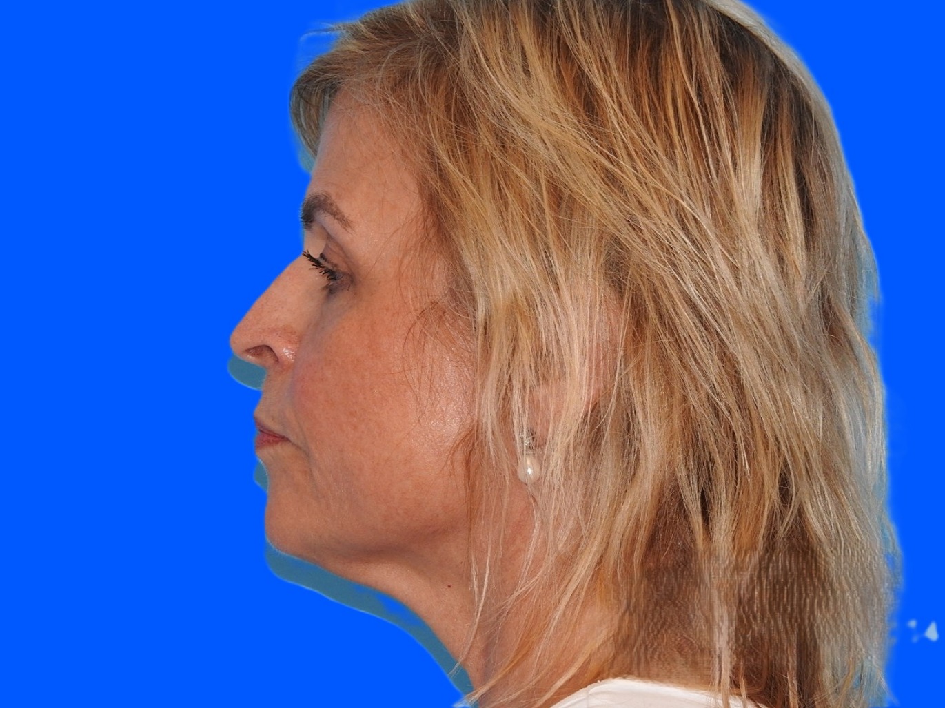 Before Image: Patient Case #0121 - left-side