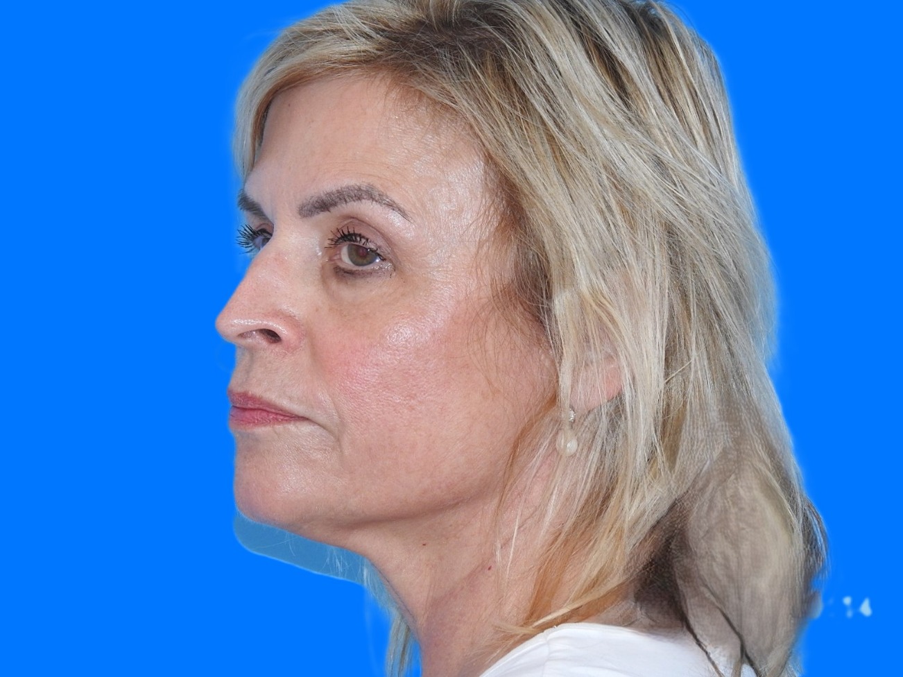 Before Image: Patient Case #0121 - left-front-oblique