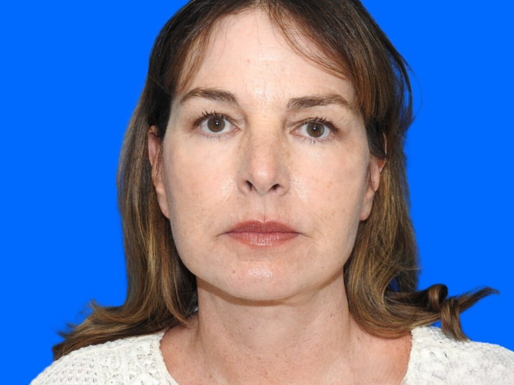 After Image: Patient Case #0123 - front