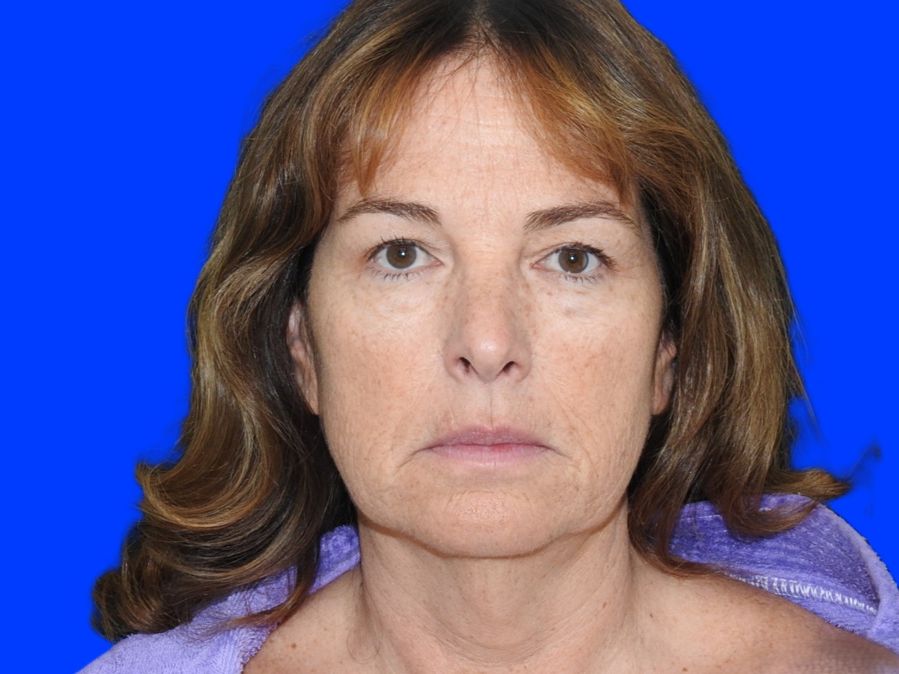 Before Image: Patient Case #0123 - front