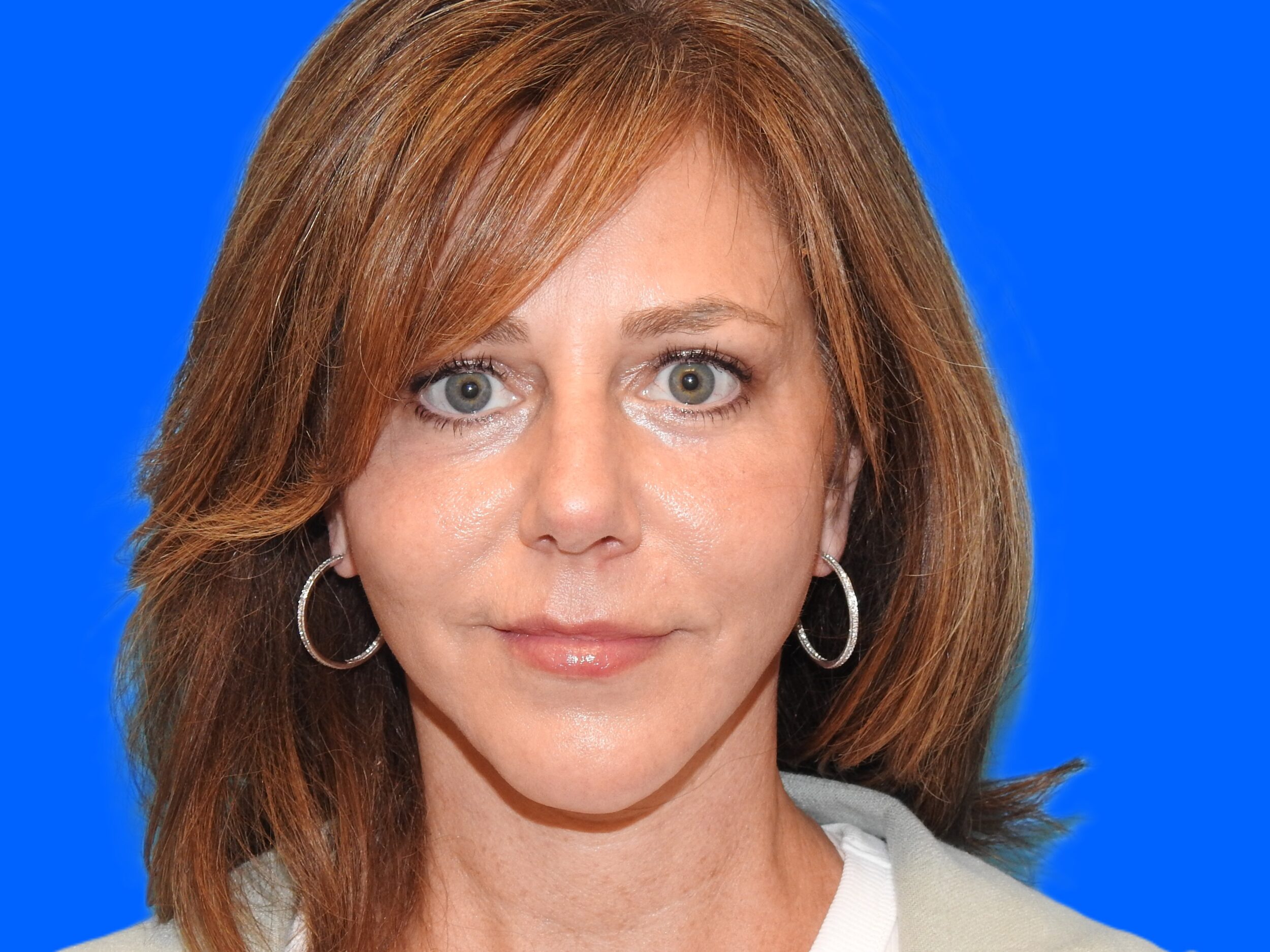 After Image: Patient Case #0124 - front