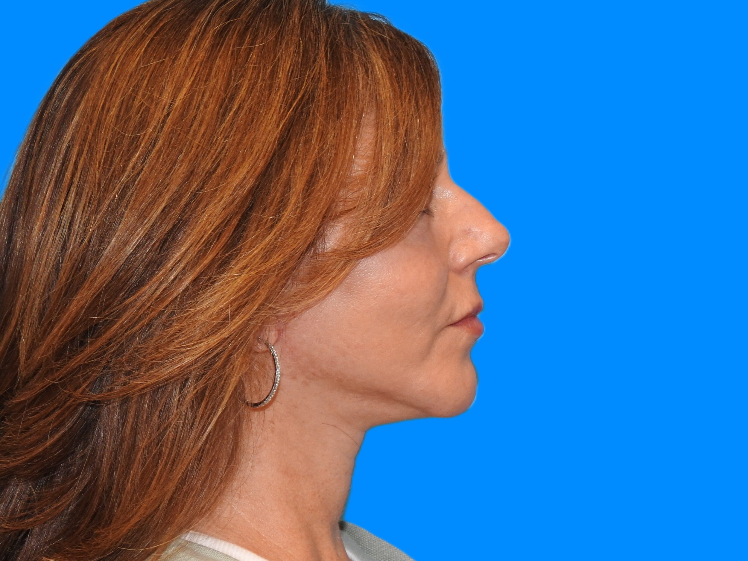 After Image: Patient Case #0124 - right-side