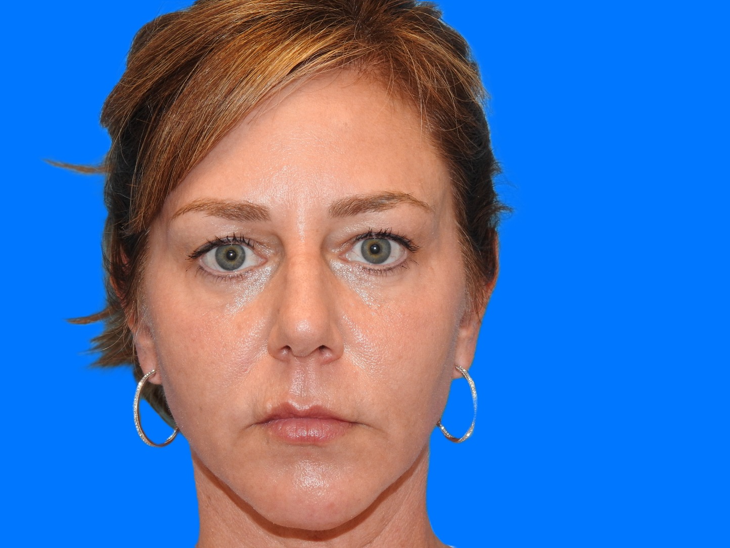 Before Image: Patient Case #0124 - front