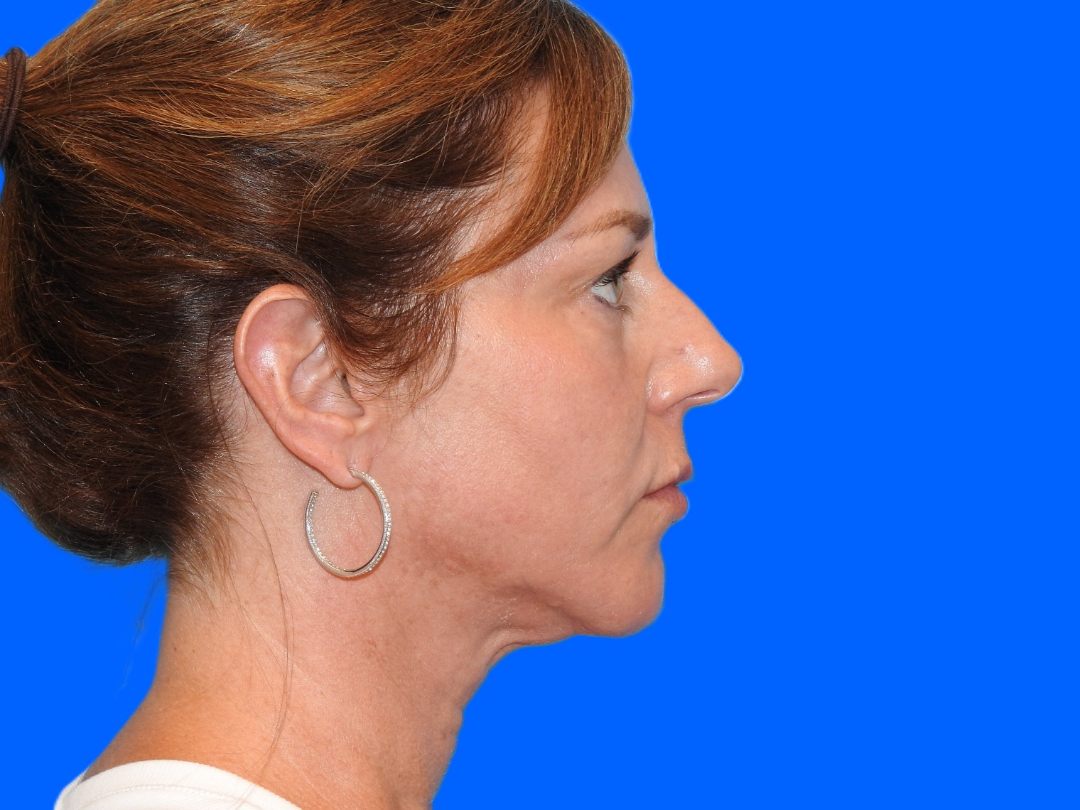 Before Image: Patient Case #0124 - right-side