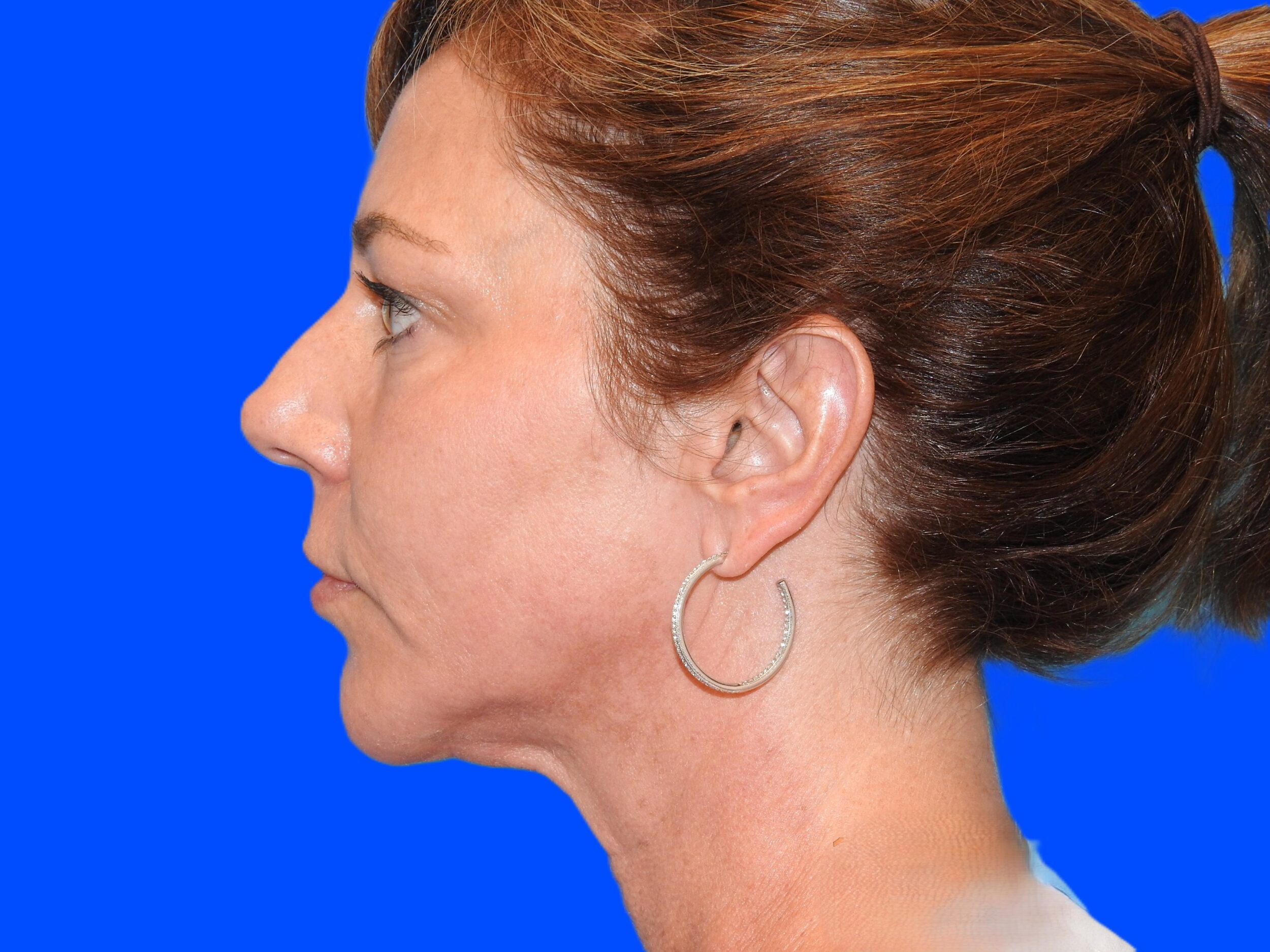Before Image: Patient Case #0124 - left-side