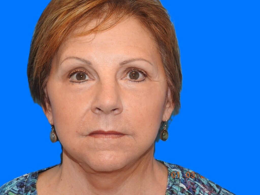 After Image: Patient Case #0125 - front