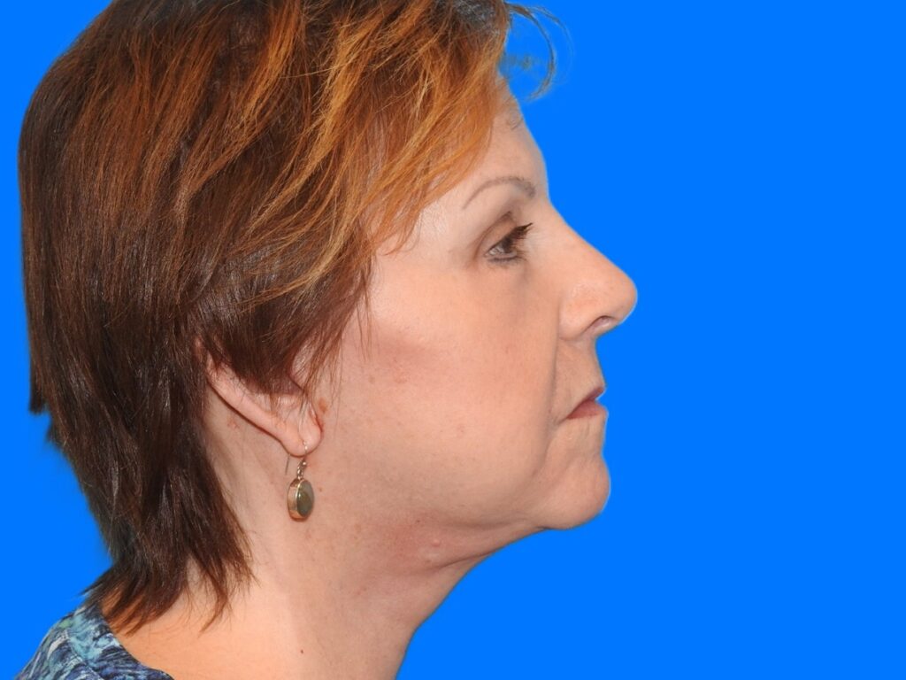 After Image: Patient Case #0125 - right-side