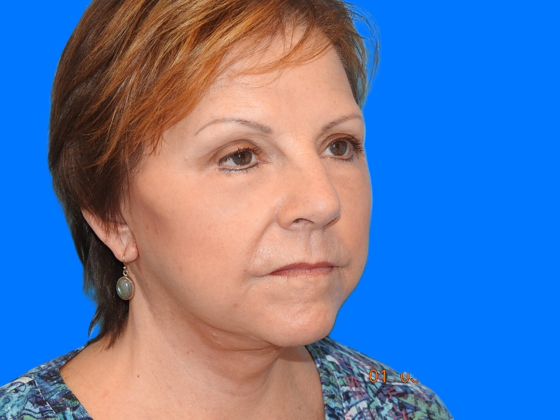 After Image: Patient Case #0125 - right-front-oblique