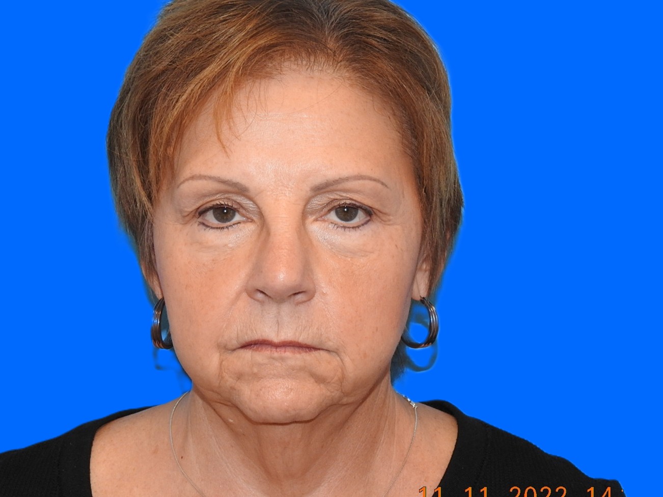 Before Image: Patient Case #0125 - front