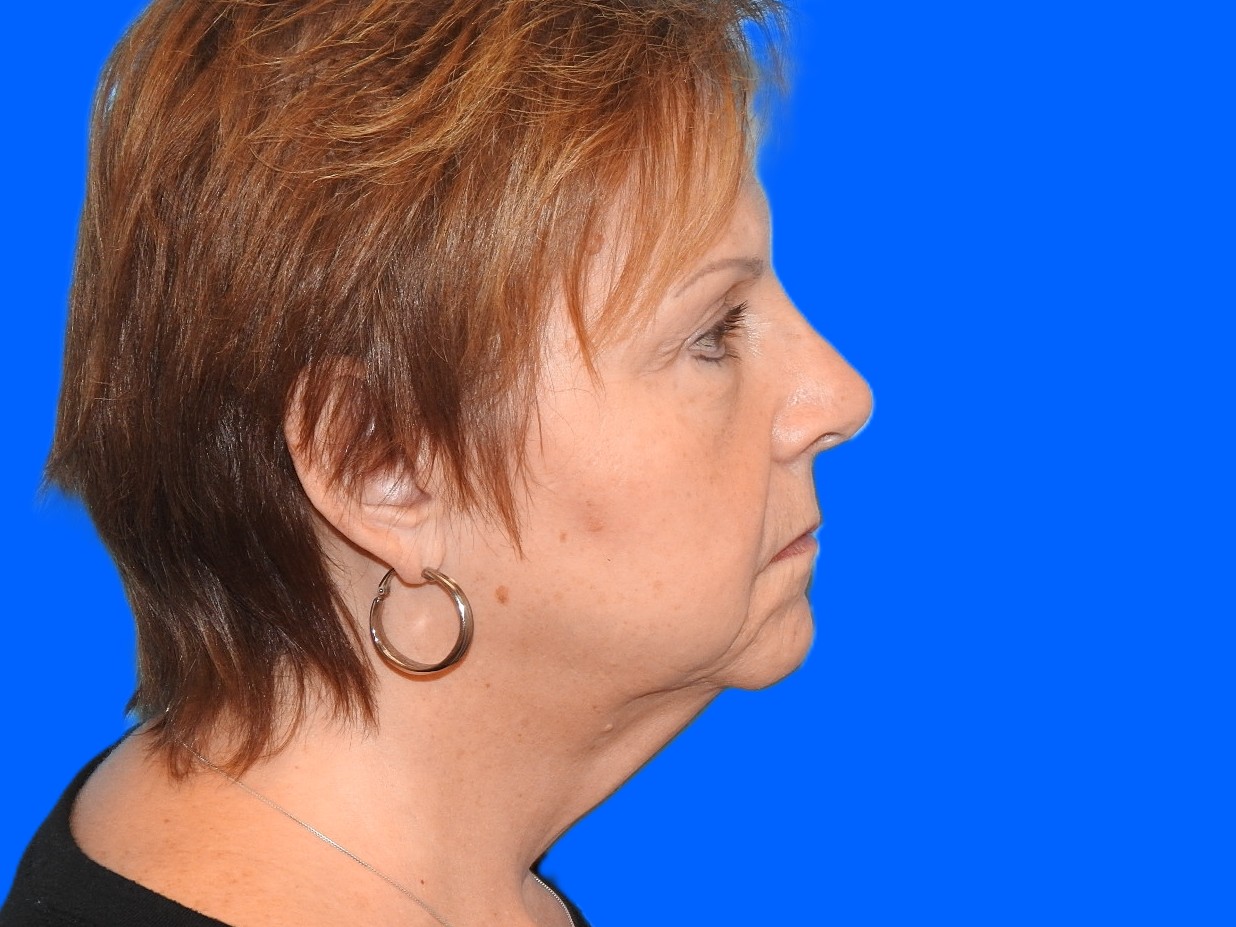 Before Image: Patient Case #0125 - right-side