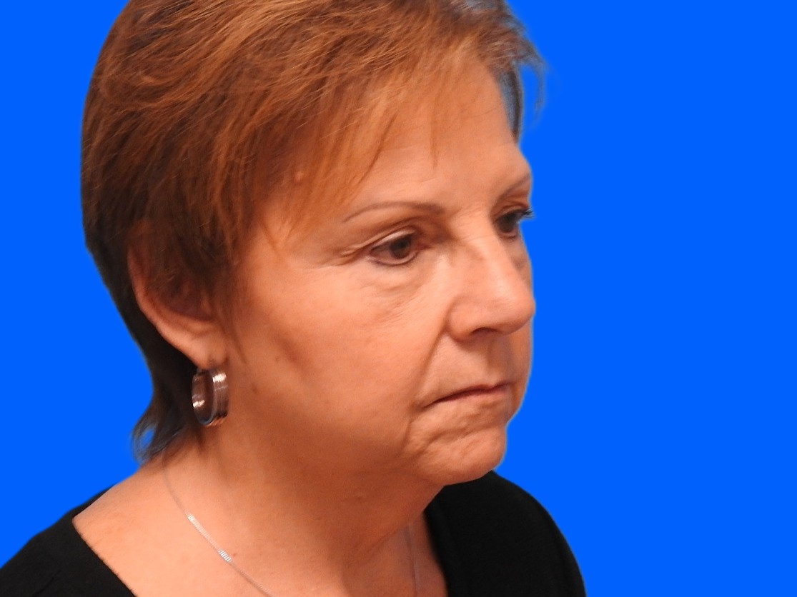 Before Image: Patient Case #0125 - right-front-oblique