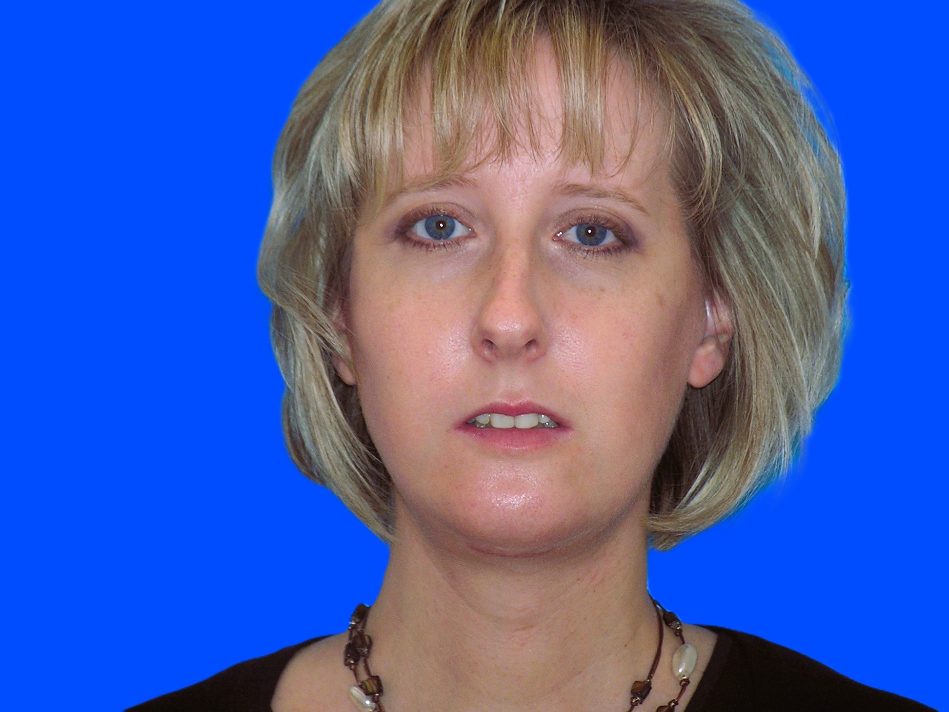 After Image: Patient Case #0126 - front