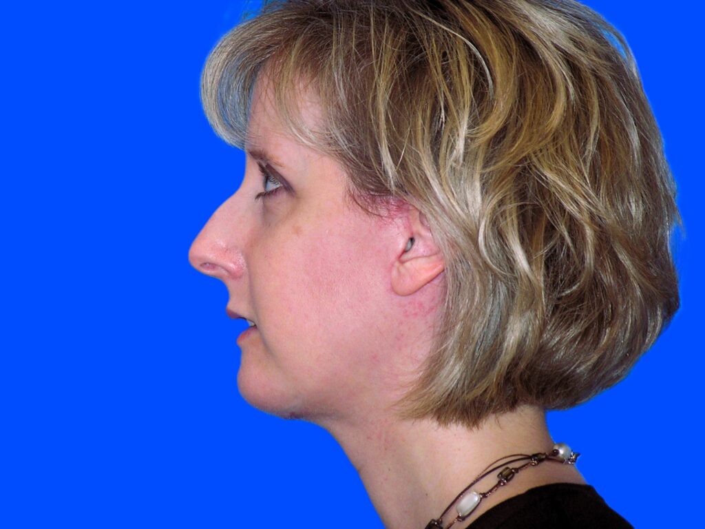 After Image: Patient Case #0126 - left-side